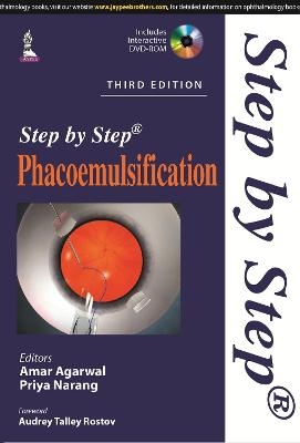 Step by Step Phacoemulsification - 