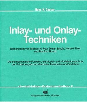 Inlay- und Onlay-Techniken - Hans H Caesar