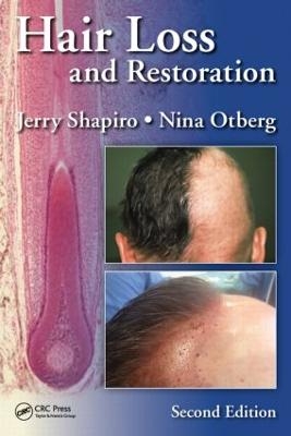 Hair Loss and Restoration - Jerry Shapiro, Nina Otberg