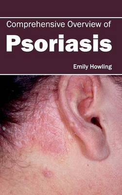 Comprehensive Overview of Psoriasis - 