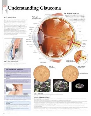 Understanding Glaucoma Laminated Poster -  Scientific Publishing