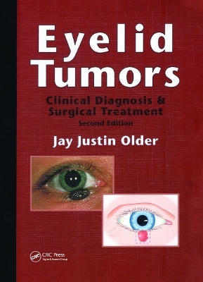 Eyelid Tumors - Jay Justin Older