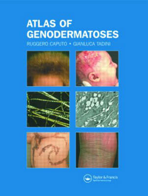 Atlas of Genodermatoses - Ruggero Caputo, Gianluca Tadini