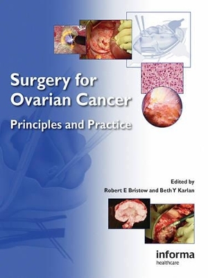 Surgery for Ovarian Cancer - 