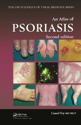 An Atlas of Psoriasis, Second Edition - Lionel Fry