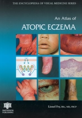 An Atlas of Atopic Eczema - Lionel Fry