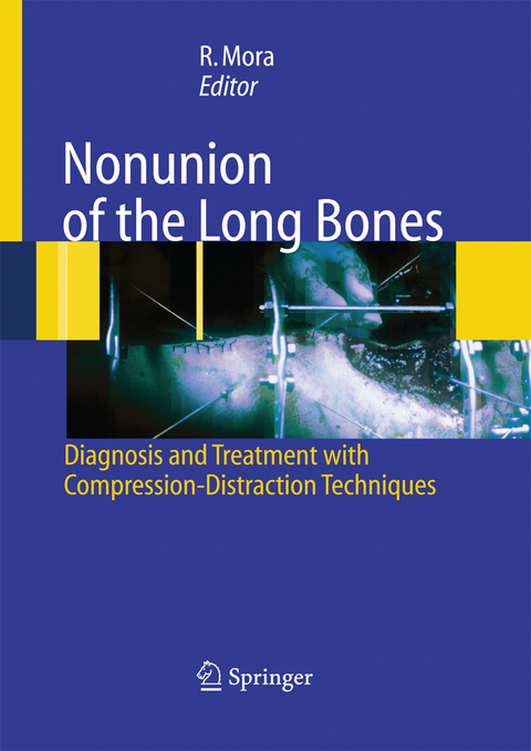 Nonunion of the Long Bones - 