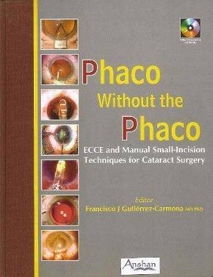 Phaco Without the Phaco - 