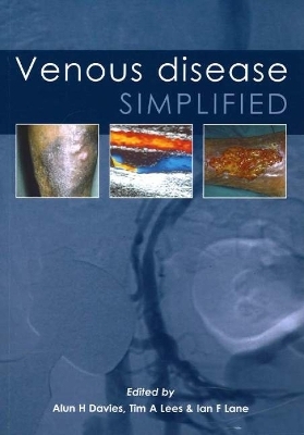 Venous Disease Simplified - 