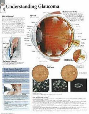 Understanding Glaucoma Paper Poster -  Scientific Publishing