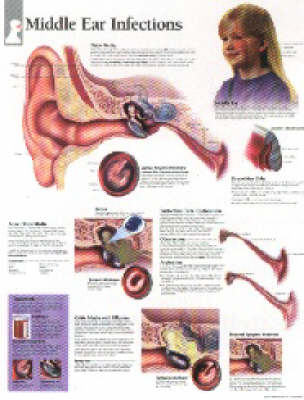 Middle Ear Infections Laminated Poster -  Scientific Publishing