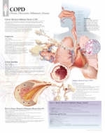 COPD (Chronic Obstructive Pulmonary Disease) Laminated Poster -  Scientific Publishing