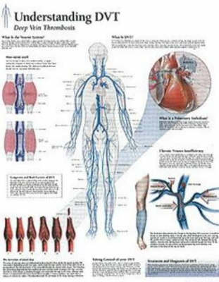 Understanding DVT Paper Poster -  Scientific Publishing