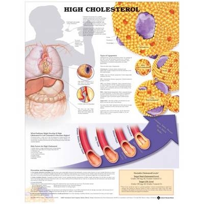 High Cholesterol Anatomical Chart