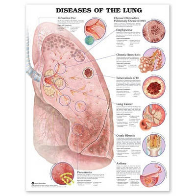 Diseases of the Lung -  Anatomical Chart Company