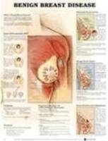 Benign Breast Disease Anatomical Chart