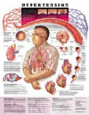 Hypertension -  Anatomical Chart Company