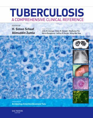 Tuberculosis - 