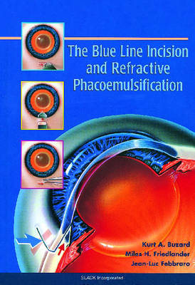 Blue Line Incision and Refractive Phacoemulsification - Kurt A. Buzard, Miles H. Friedlander, Jean-Luc Febbraro