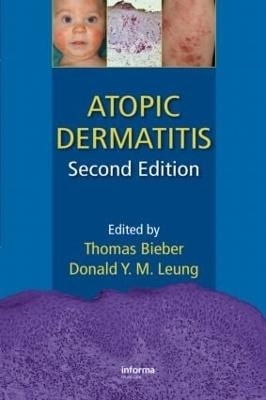 Atopic Dermatitis - 