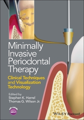 Minimally Invasive Periodontal Therapy - Stephen K. Harrel, Thomas G. Wilson