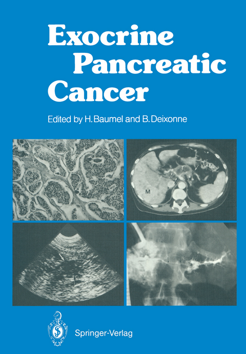 Exocrine Pancreatic Cancer - 