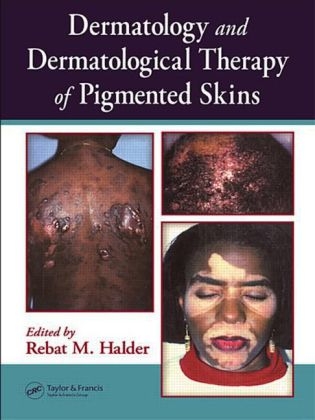 Dermatology and Dermatological Therapy of Pigmented Skins - 