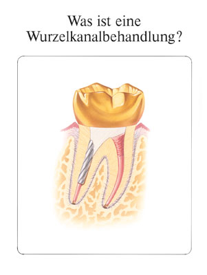 Was ist eine Wurzelkanalbehandlung? - Joel M Berns