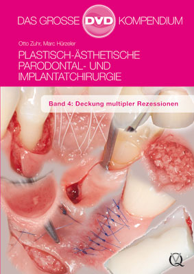 Plastisch-Ästhetische Parodontal- und Implantatchirurgie - Otto Zuhr, Marc Hürzeler