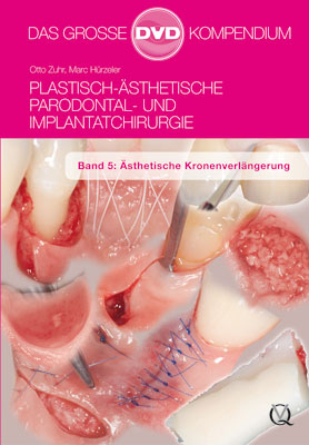 Plastisch-Ästhetische Parodontal- und Implantatchirurgie - Otto Zuhr, Marc Hürzeler