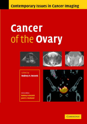 Cancer of the Ovary - 