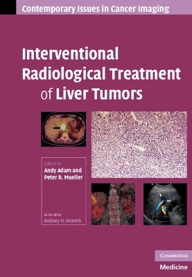 Interventional Radiological Treatment of Liver Tumors - 