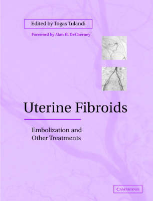 Uterine Fibroids - 