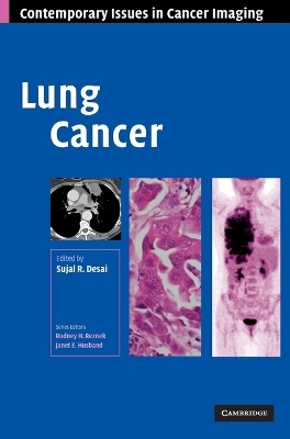 Lung Cancer - 