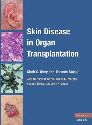 Skin Disease in Organ Transplantation - 