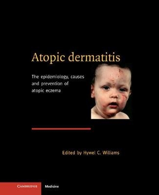 Atopic Dermatitis - 