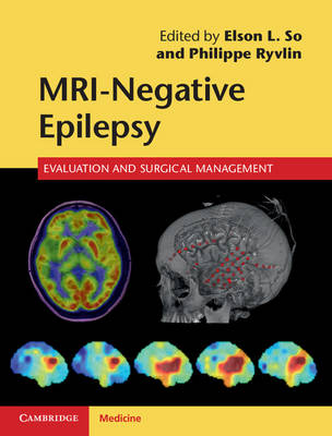 MRI - Negative Epilepsy - 