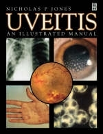 Uveitis - Nicholas Jones