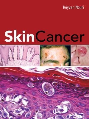 Skin Cancer - Keyvan Nouri