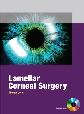 Lamellar Corneal Surgery - Thomas John