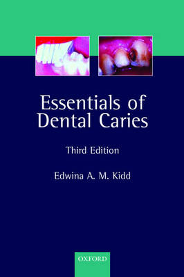 Essentials of Dental Caries - Edwina A. M. Kidd