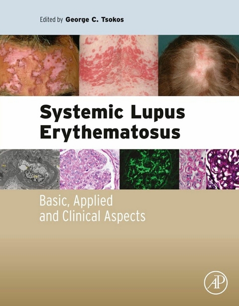 Systemic Lupus Erythematosus - 