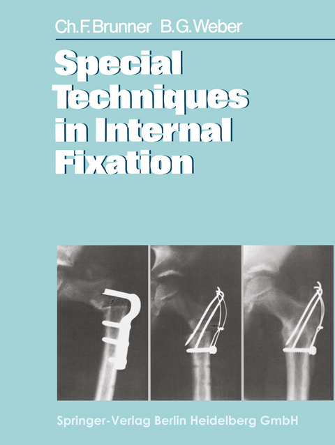 Special Techniques in Internal Fixation - C. F. Brunner, B. G. Weber