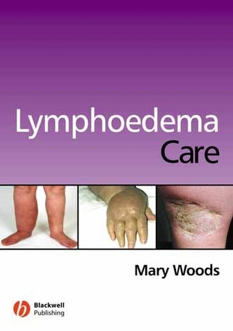 Lymphoedema Care - Mary Elizabeth Woods