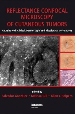 Reflectance Confocal Microscopy of Cutaneous Tumors - 