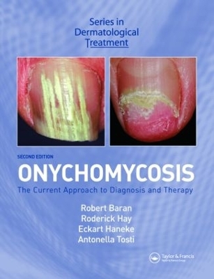 Onychomycosis - 