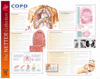 Frank H. Netter Chronic Obstructive Pulmonary Disease Poster - Richard Shenderey