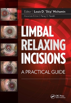 Limbal Relaxing Incisions - Louis Nichamin