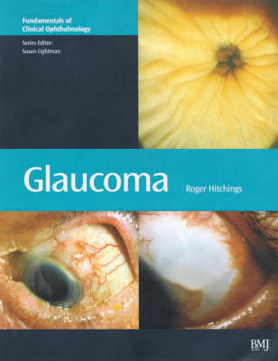 Glaucoma - 