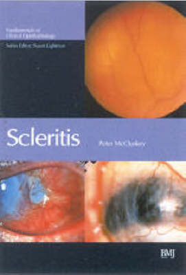 Scleritis - 